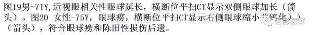 眼球外伤:影像医生阅片必须注意的地方 眼球外伤:影像医生阅片必须注意的地方