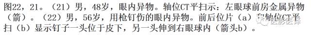 眼球外伤:影像医生阅片必须注意的地方 眼球外伤:影像医生阅片必须注意的地方