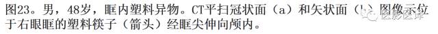 眼球外伤:影像医生阅片必须注意的地方 眼球外伤:影像医生阅片必须注意的地方