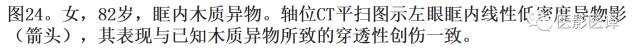 眼球外伤:影像医生阅片必须注意的地方 眼球外伤:影像医生阅片必须注意的地方