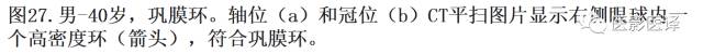 眼球外伤:影像医生阅片必须注意的地方 眼球外伤:影像医生阅片必须注意的地方