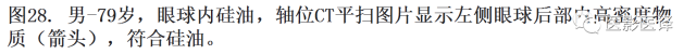 眼球外伤:影像医生阅片必须注意的地方 眼球外伤:影像医生阅片必须注意的地方
