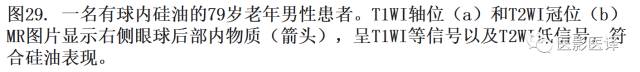 眼球外伤:影像医生阅片必须注意的地方 眼球外伤:影像医生阅片必须注意的地方