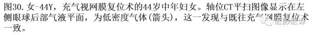 眼球外伤:影像医生阅片必须注意的地方 眼球外伤:影像医生阅片必须注意的地方