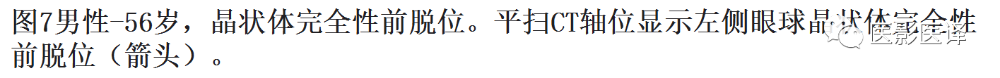 眼球外伤:影像医生阅片必须注意的地方 眼球外伤:影像医生阅片必须注意的地方