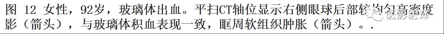 眼球外伤:影像医生阅片必须注意的地方 眼球外伤:影像医生阅片必须注意的地方