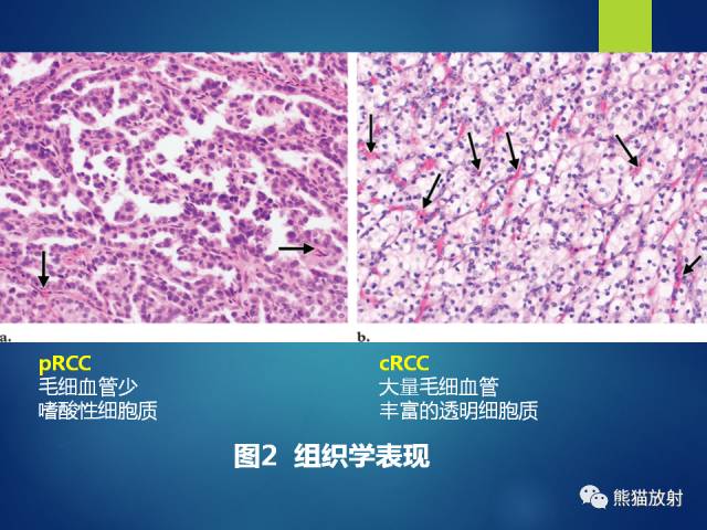 【PPT】乳头状肾细胞癌--影像病理相关性