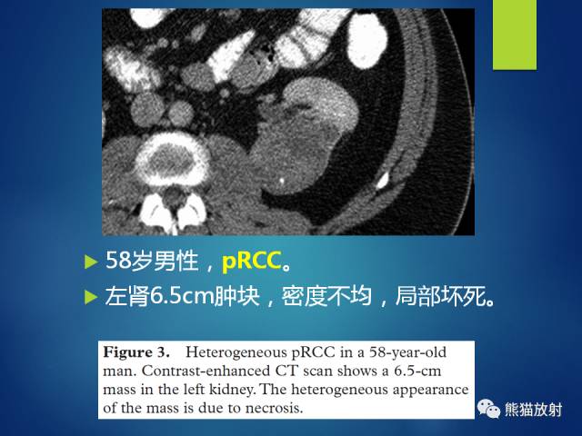 【PPT】乳头状肾细胞癌--影像病理相关性