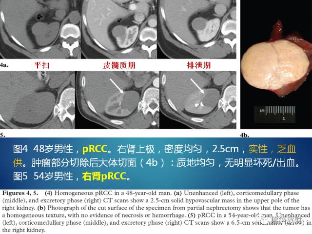 【PPT】乳头状肾细胞癌--影像病理相关性