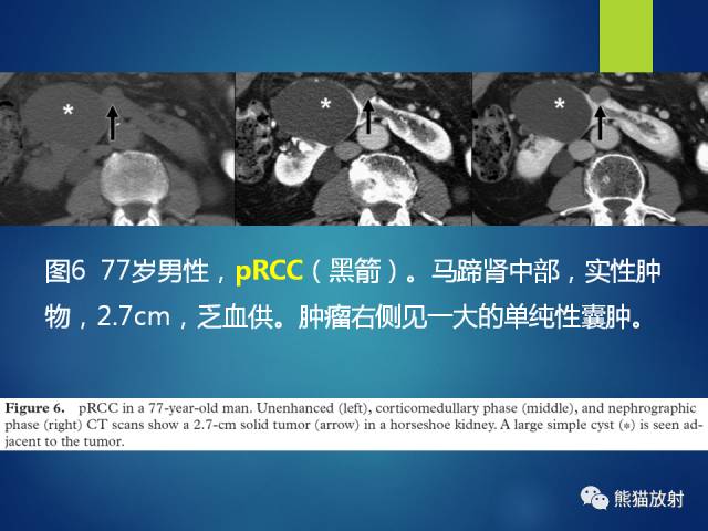 【PPT】乳头状肾细胞癌--影像病理相关性