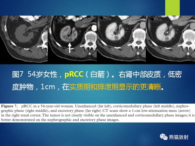 【PPT】乳头状肾细胞癌--影像病理相关性