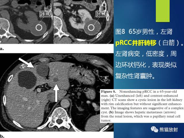 【PPT】乳头状肾细胞癌--影像病理相关性