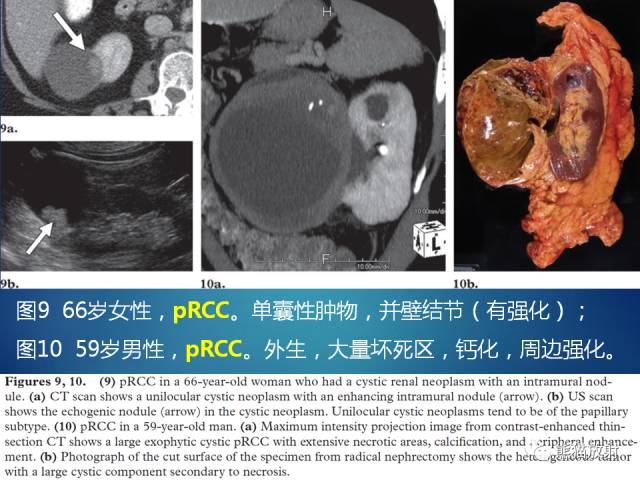 【PPT】乳头状肾细胞癌--影像病理相关性