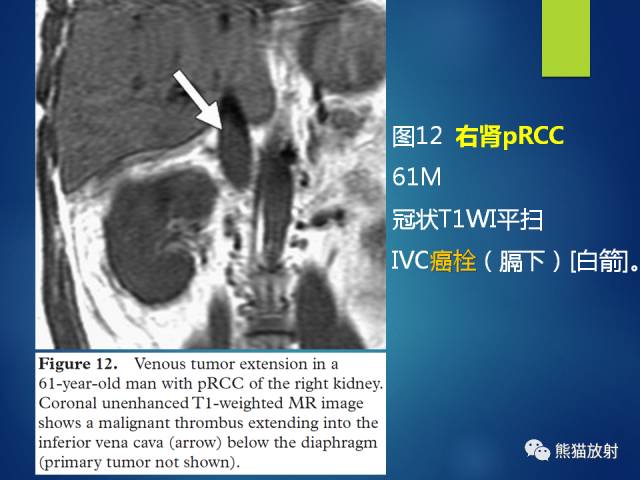 【PPT】乳头状肾细胞癌--影像病理相关性