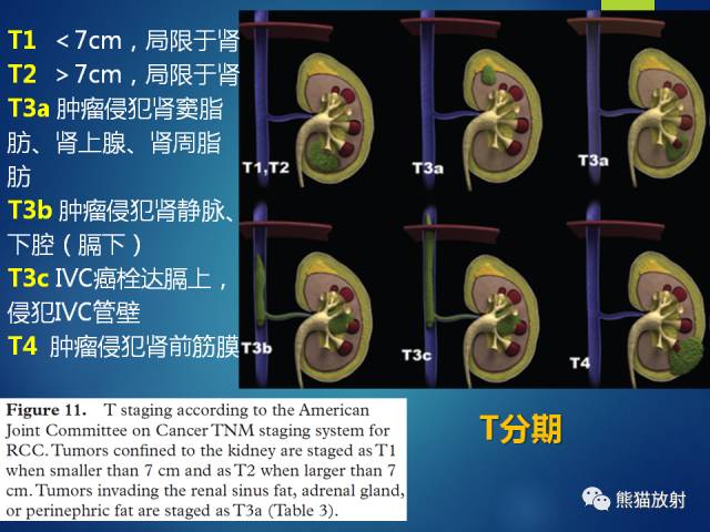 【PPT】乳头状肾细胞癌--影像病理相关性