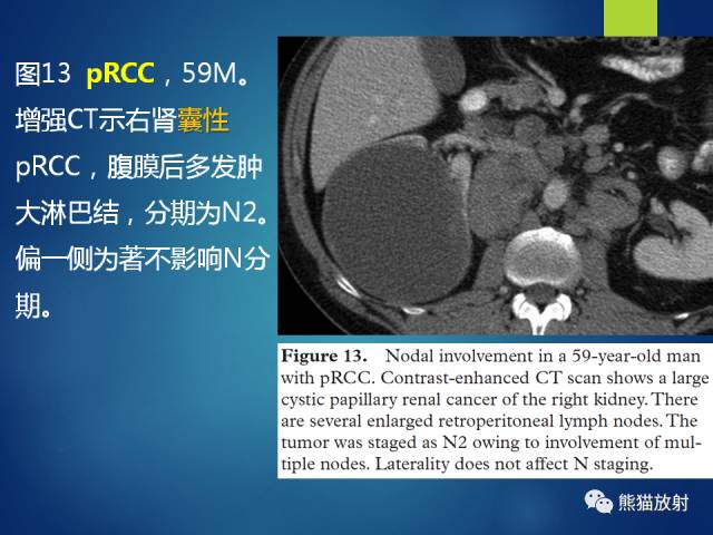 【PPT】乳头状肾细胞癌--影像病理相关性