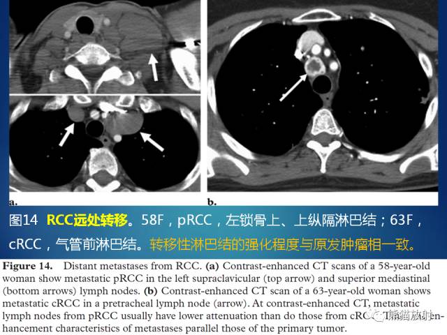 【PPT】乳头状肾细胞癌--影像病理相关性