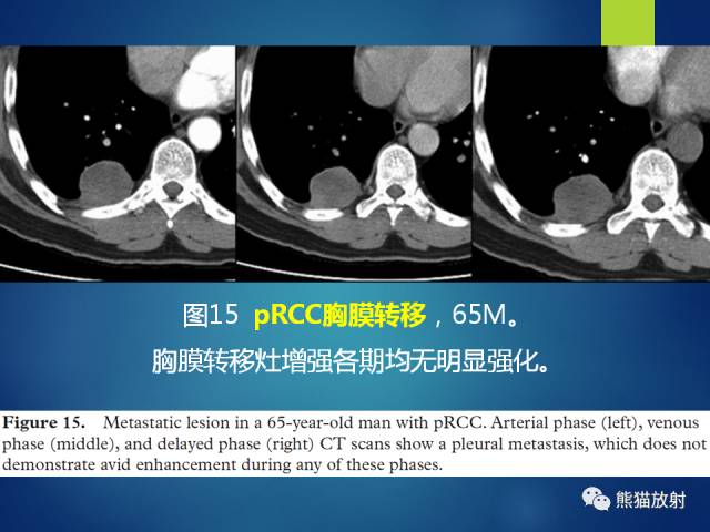 【PPT】乳头状肾细胞癌--影像病理相关性