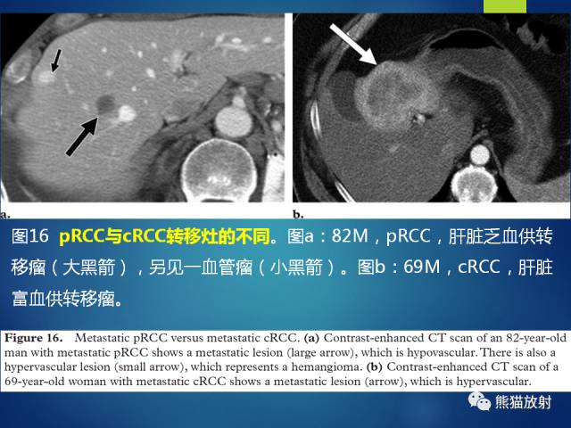 【PPT】乳头状肾细胞癌--影像病理相关性