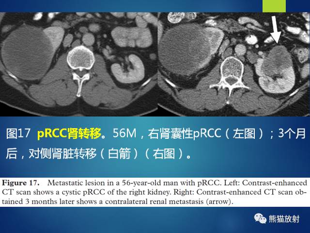 【PPT】乳头状肾细胞癌--影像病理相关性