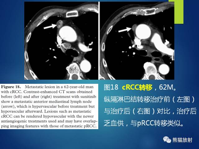 【PPT】乳头状肾细胞癌--影像病理相关性