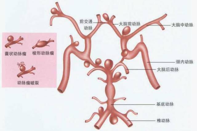 脑子里的定时炸弹——颅内动脉瘤 脑子里的定时炸弹——颅内动脉瘤