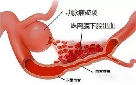 脑子里的定时炸弹——颅内动脉瘤 脑子里的定时炸弹——颅内动脉瘤