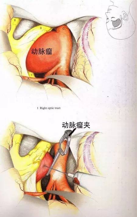 脑子里的定时炸弹——颅内动脉瘤 脑子里的定时炸弹——颅内动脉瘤