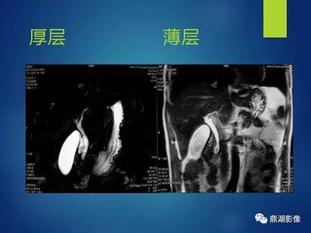 【PPT】MRCP在胆道系统疾病中的诊断价值