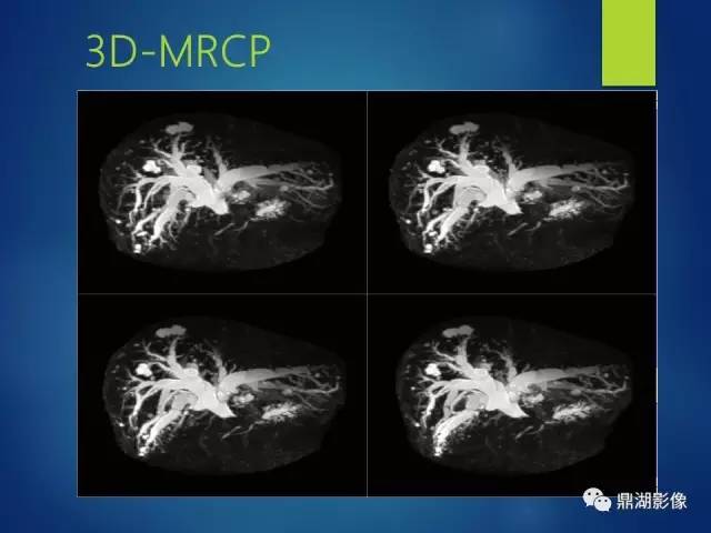 【PPT】MRCP在胆道系统疾病中的诊断价值