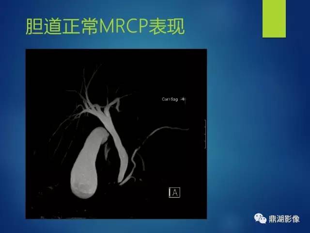 【PPT】MRCP在胆道系统疾病中的诊断价值