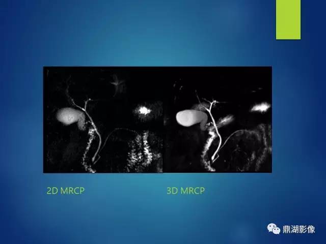 【PPT】MRCP在胆道系统疾病中的诊断价值