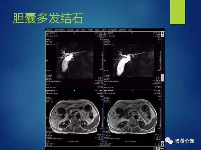 【PPT】MRCP在胆道系统疾病中的诊断价值