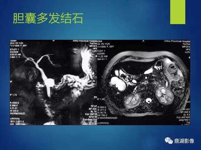 【PPT】MRCP在胆道系统疾病中的诊断价值