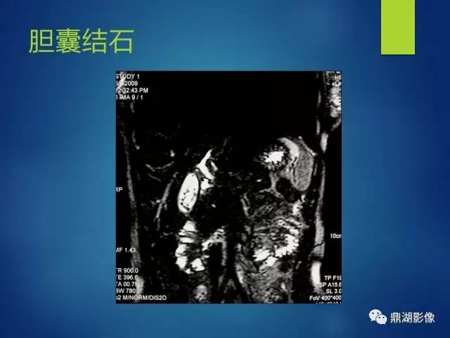 【PPT】MRCP在胆道系统疾病中的诊断价值