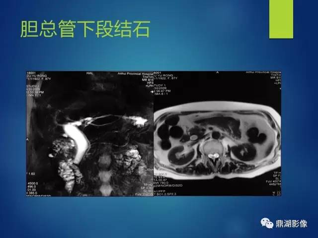 【PPT】MRCP在胆道系统疾病中的诊断价值
