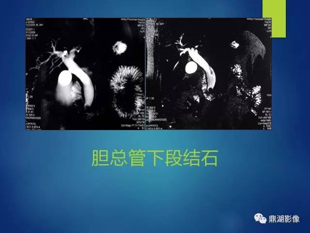 【PPT】MRCP在胆道系统疾病中的诊断价值