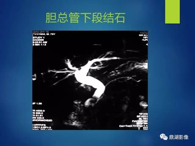【PPT】MRCP在胆道系统疾病中的诊断价值