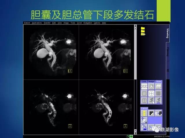 【PPT】MRCP在胆道系统疾病中的诊断价值