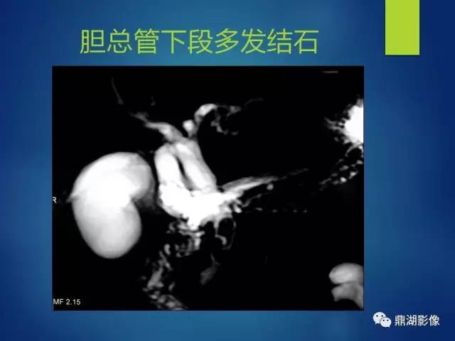 【PPT】MRCP在胆道系统疾病中的诊断价值