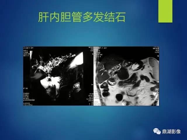 【PPT】MRCP在胆道系统疾病中的诊断价值