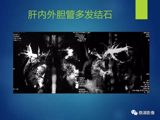 【PPT】MRCP在胆道系统疾病中的诊断价值