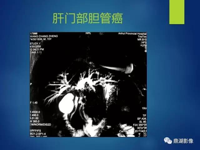 【PPT】MRCP在胆道系统疾病中的诊断价值