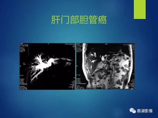 【PPT】MRCP在胆道系统疾病中的诊断价值