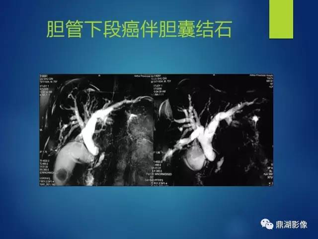 【PPT】MRCP在胆道系统疾病中的诊断价值