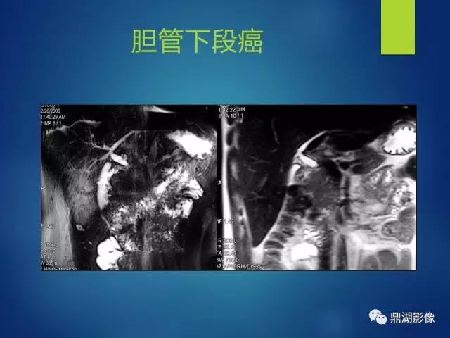 【PPT】MRCP在胆道系统疾病中的诊断价值