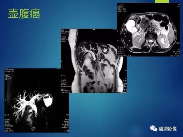 【PPT】MRCP在胆道系统疾病中的诊断价值