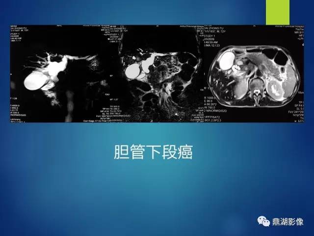 【PPT】MRCP在胆道系统疾病中的诊断价值