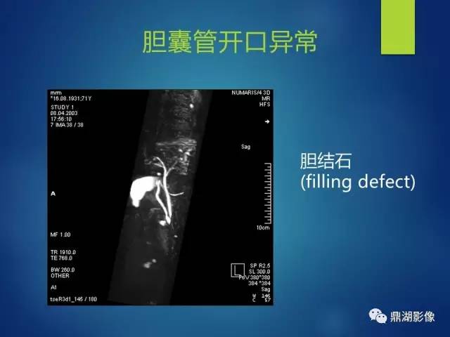 【PPT】MRCP在胆道系统疾病中的诊断价值