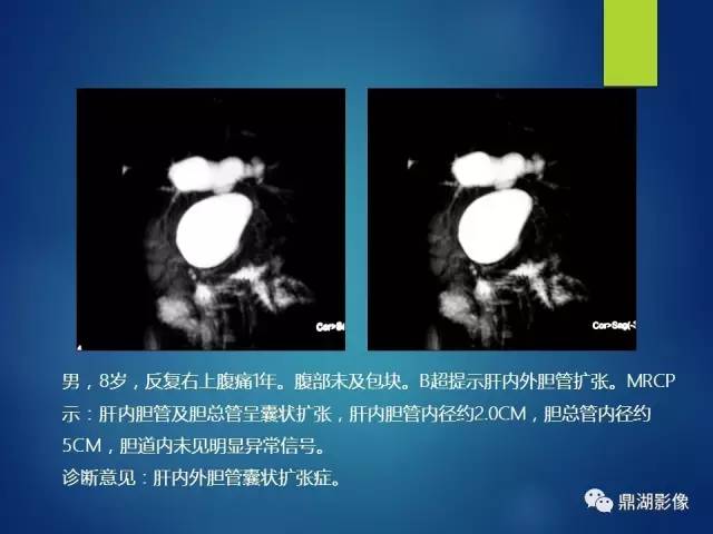 【PPT】MRCP在胆道系统疾病中的诊断价值